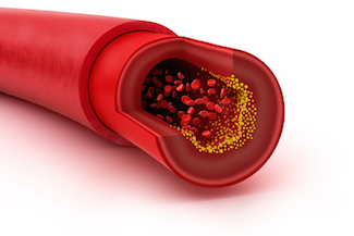 Cholesterol plaque in blood vessel, 3D illustration